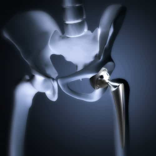 Why Mexico is a Top Destination for Hip Replacement Surgery?